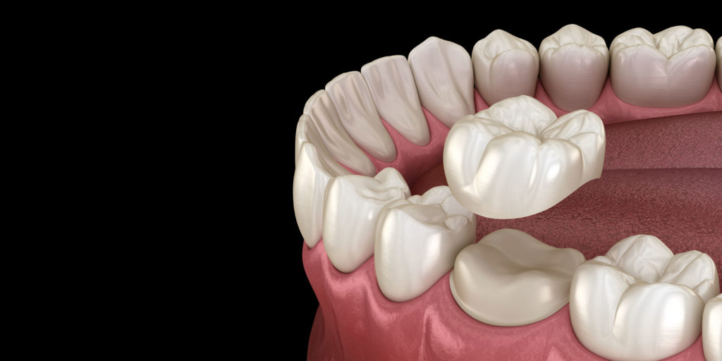 dental crowns model