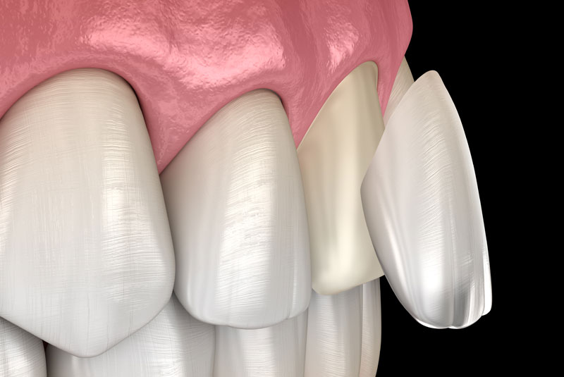 dental veneers graphic