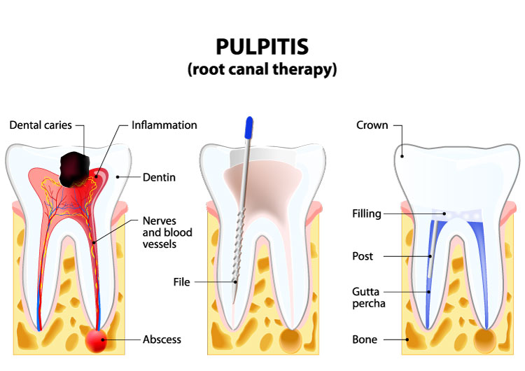 illustration root canal therapy