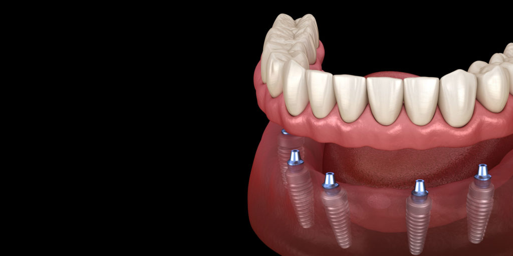 implant supported dentures model